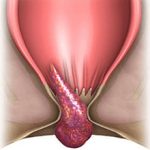 Геморройная шишка: причины, симптомы и как лечить