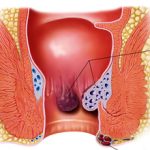 Появление шишки в заднем проходе: причины, симптомы и как лечить
